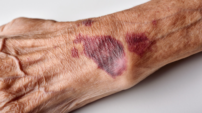 Bruise on an Elderly's Arm