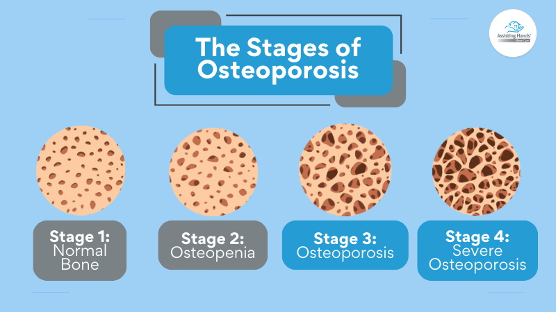 The Stages of Osteoporosis - Assisting Hands