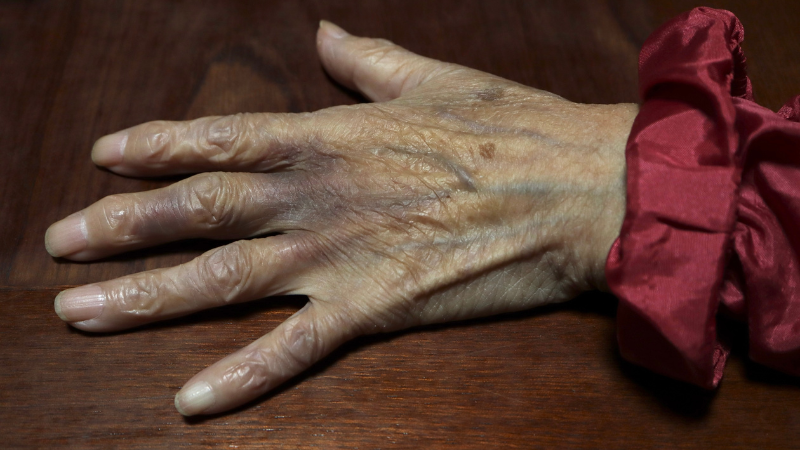 Common Causes of Bruises in the Elderly - Assisting Hands Home Care