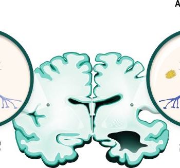 Assisting Hands® Centennial_Compassionate Alzheimers Care In Denver