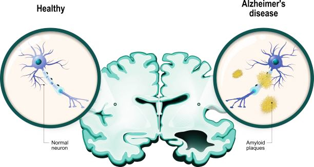 Assisting Hands® Centennial_Compassionate Alzheimers Care In Denver