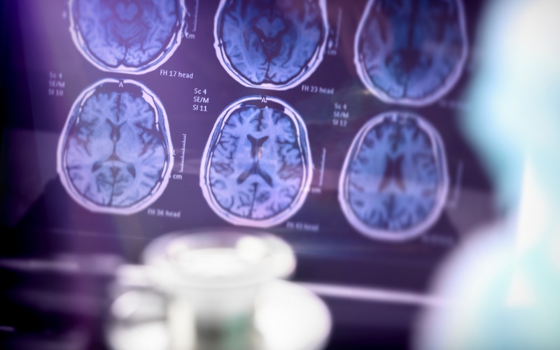 What Types of Memory Loss are Treatable