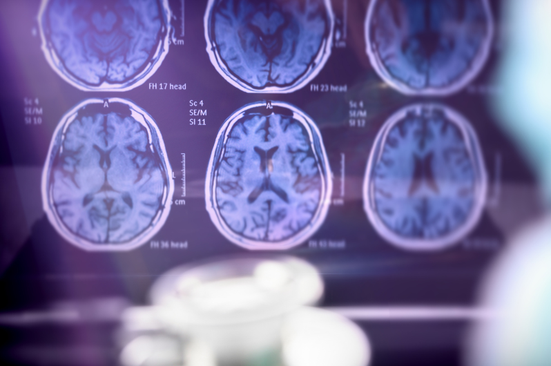 early-alzheimers-symptoms-dana-point-ca